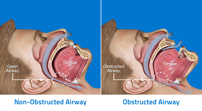 229886-Anatomy-of-Obstructive-Sleep-Apnea