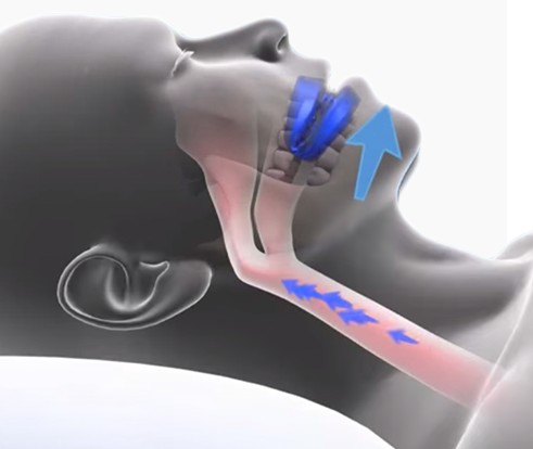 ที่ครอบฟัน (mandibular advancement splint; MAS)