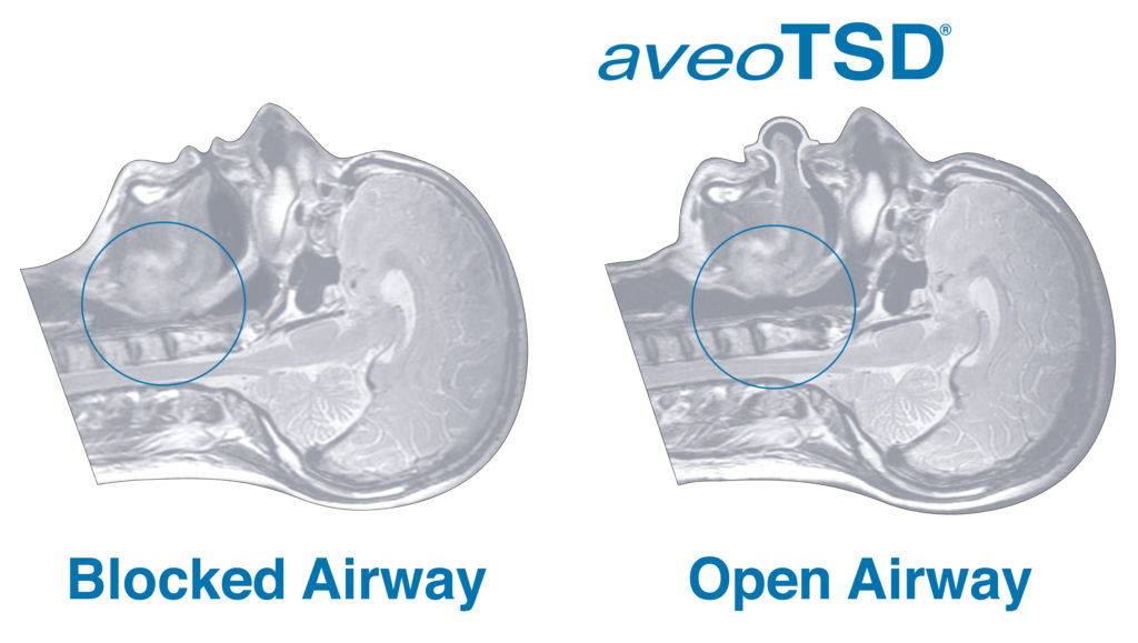 อุปกรณ์ยึดลิ้น (tongue stabilizing device,TSD)